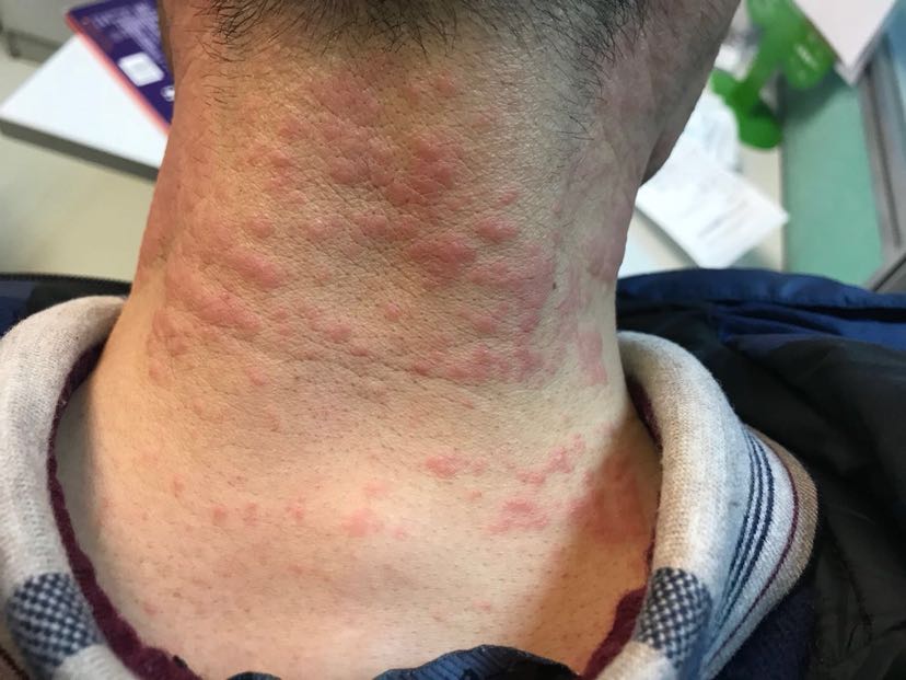 1、膏藥過敏怎么辦？
