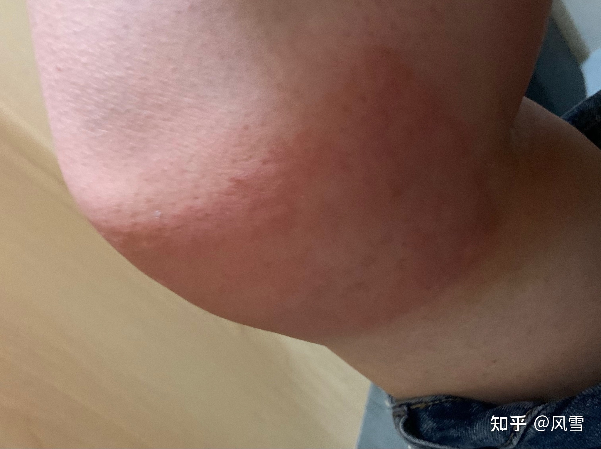 1、貼膏藥過敏癢紅腫怎么辦？