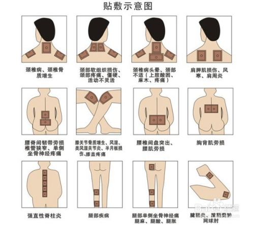 1、肩痛買(mǎi)什么膏藥可以貼？